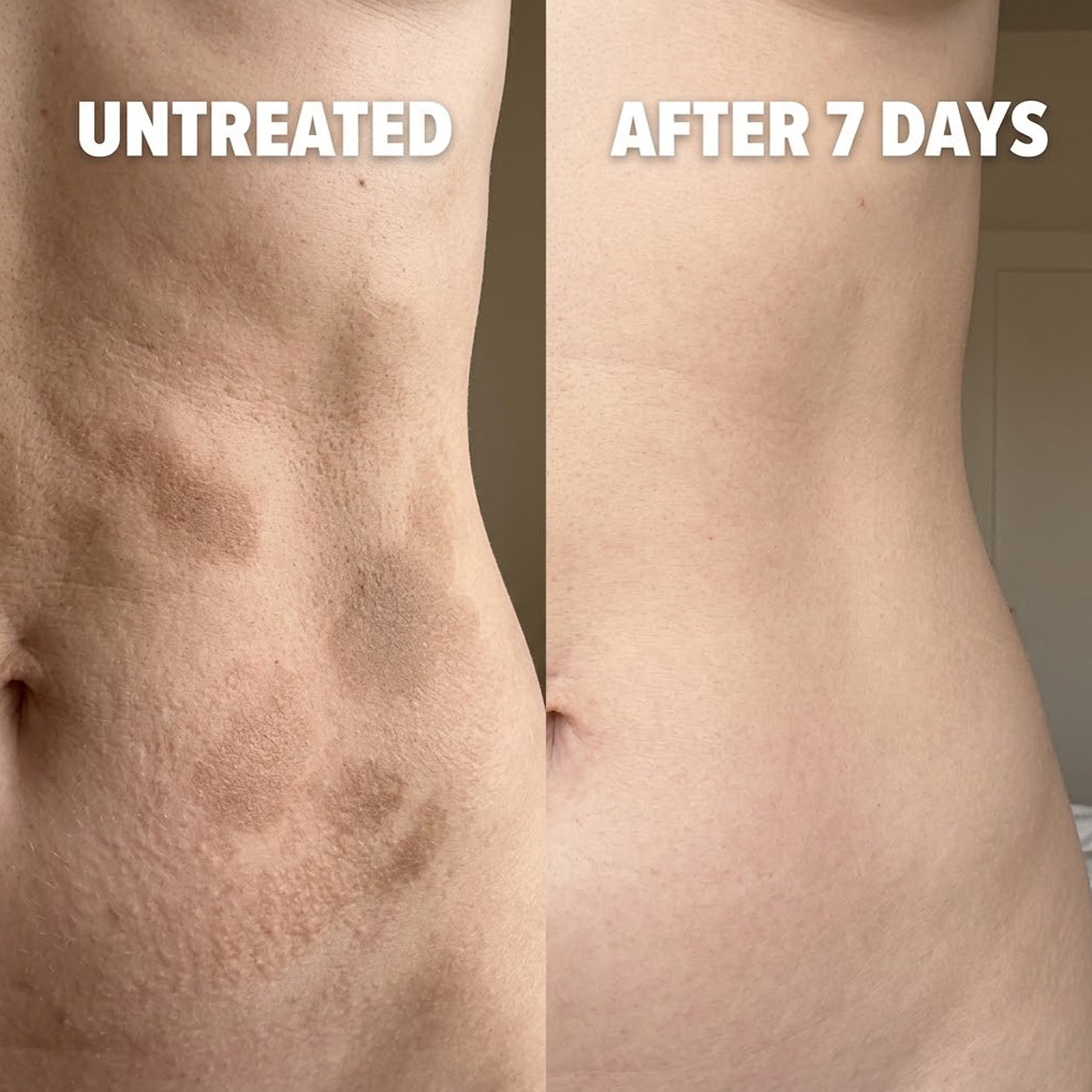 Cellular-Level Delivery Triple Acid Complex For Hyperpigmentation