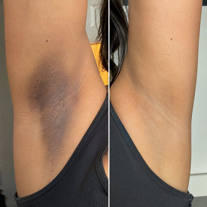 Cellular-Level Delivery Triple Acid Complex For Hyperpigmentation