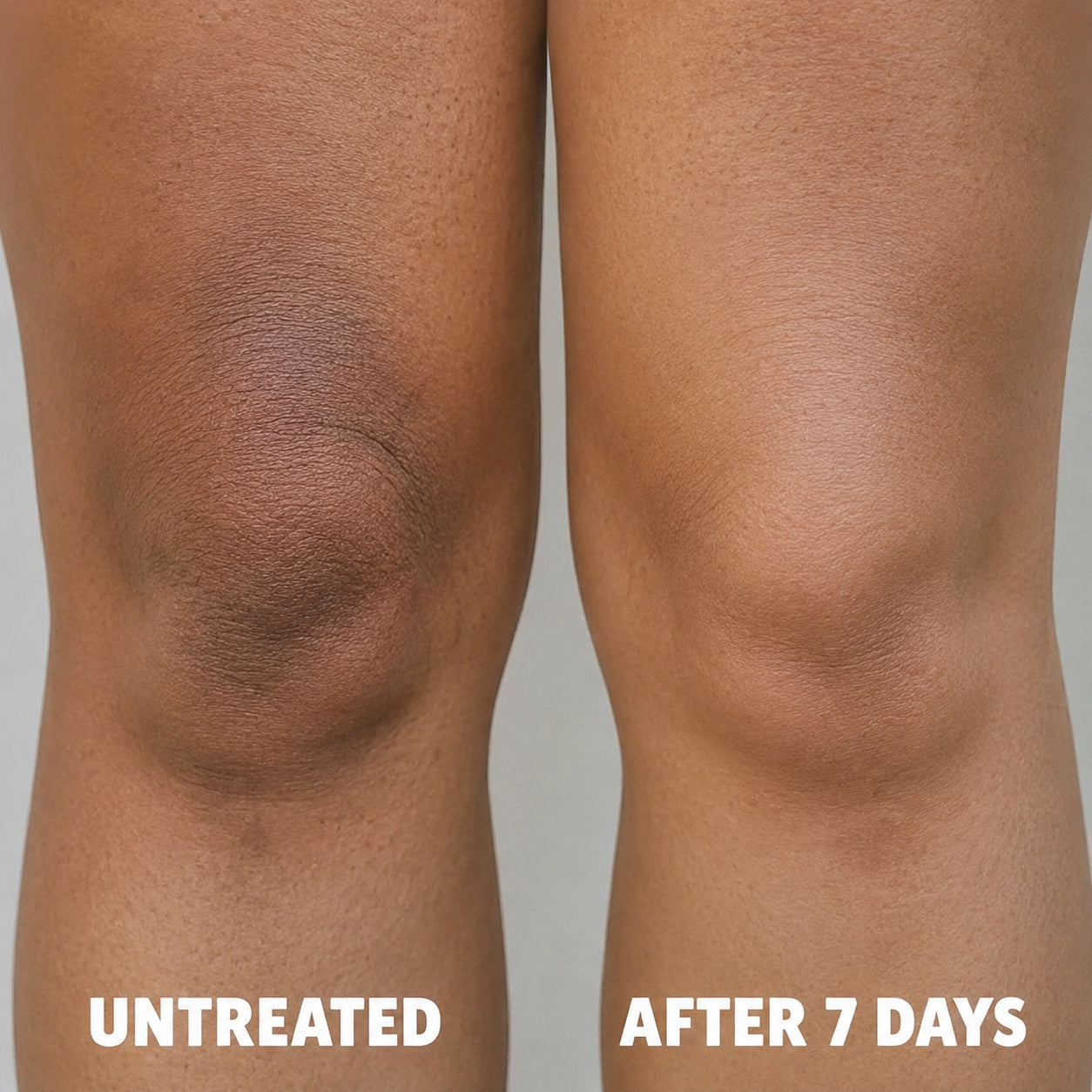 Cellular-Level Delivery Triple Acid Complex For Hyperpigmentation